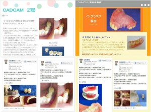 CAD/CAMZ冠・ノンクラスプデンチャー（ウェルデンツ）ＨＰ追加制作と･･･