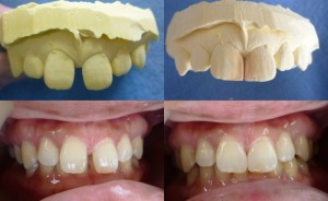 審美歯科の症例（正中の隙間＝保険・短期間）