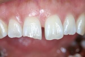 前歯の隙間　症例　矯正やオールセラミックだけではない改善方法