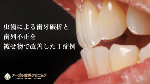 虫歯による歯牙破折と歯列不正を被せ物で改善した１症例