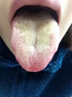 舌の汚れから発がん性物質が発生していることがわかりました