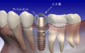 インプラントはどのくらいもつの？