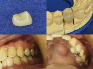 小臼歯に白いクラウンがCAD･CAMで保険適用!！！が・・・！