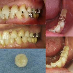 CAD･CAM冠（白いハイブリッド冠）が小臼歯に保険適用になって！