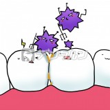 通常の歯ブラシではみがきにくい、歯と歯の間のみがき残しからばい菌が増殖しているイラスト
